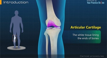 Picture of Carticel Procedures