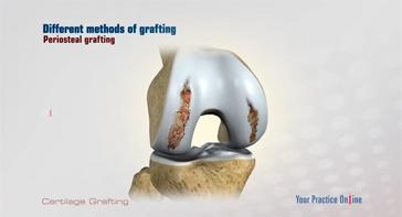 Picture of Cartilage Grafting