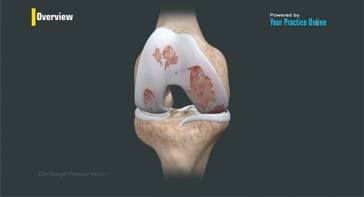 Picture of Cartilage Restoration