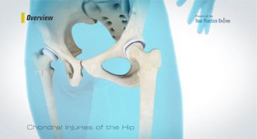 Picture of Chondral Injuries of Hip