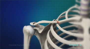 Picture of Clavicle Fracture