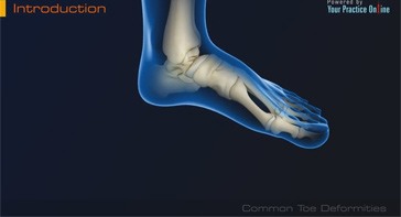 Picture of Common Toe Deformities