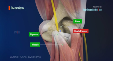 Picture of Cubital Tunnel Syndrome