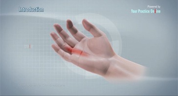 Picture of Dupuytrens Contracture