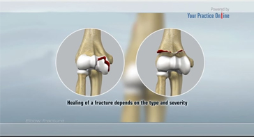Picture of Elbow Fracture