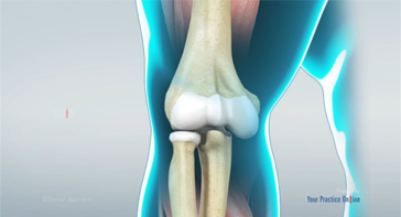 Picture of Elbow Sprain