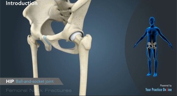 Picture of Femoral Neck Fracture
