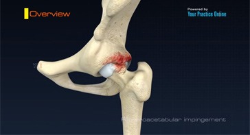 Picture of Femoroacetabular Impingement