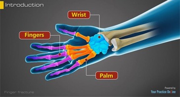 Picture of Finger Fractures