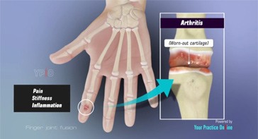Picture of Finger Joint Fusion