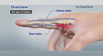 Picture of Flexor Tendon Injuries