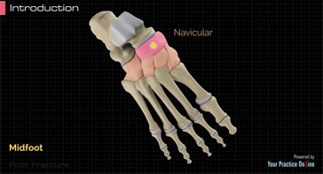Picture of Foot Fracture