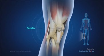 Picture of Fractures of the Patella