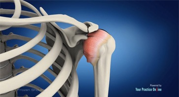 Picture of Frozen Shoulder