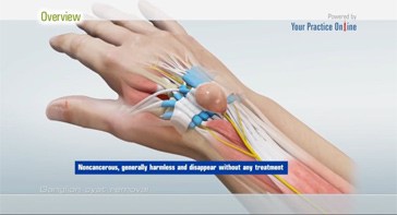 Picture of Ganglion Cyst Removal