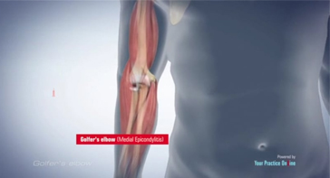 Picture of Golfer Elbow