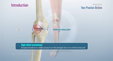 Picture of High Tibial Osteotomy