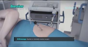 Picture of Hip Arthroscopy