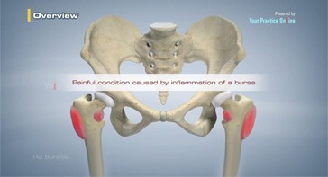 Picture of Hip Bursitis
