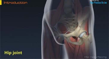 Picture of Hip Resurfacing