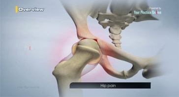 Picture of Hip Synovitis