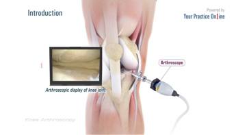 Picture of Knee Arthroscopy