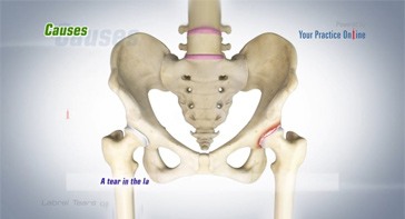Picture of Labral Tears of the Hip