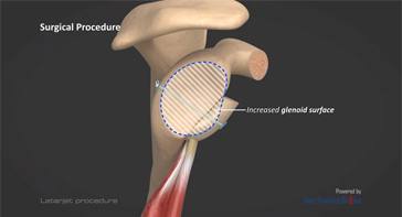 Picture of Latarjet Procedure