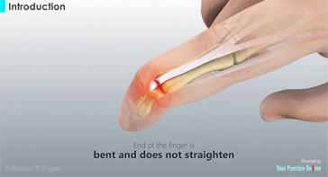 Picture of Mallet Finger