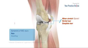 Picture of Medial Collateral Ligament Reconstruction