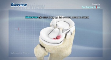 Picture of Meniscal Tears