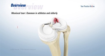 Picture of Meniscal Transplantation