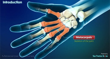Picture of Metacarpal Fractures