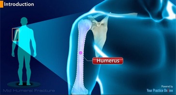 Picture of Mid Humeral Fracture