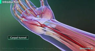 Picture of Mini-Open Carpal Tunnel Release Surgery