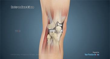 Picture of Minimally Invasive Knee Joint Replacement