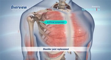 Picture of Minimally Invasive Shoulder Joint Replacement