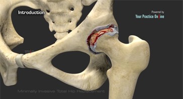 Picture of Minimally Invasive Total Hip Replacement