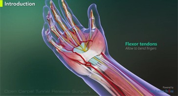 Picture of Open Carpal Tunnel Release Surgery