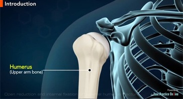 Picture of Open Reduction and Internal Fixation of Proximal Humerus Fracture