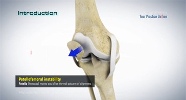 Picture of Patellofemoral Instability