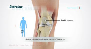 Picture of Patellofemoral Pain Syndrome