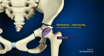 Picture of Pelvic Osteotomy