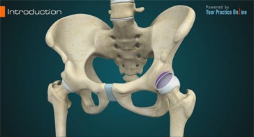 Picture of Periacetabular Osteotomy