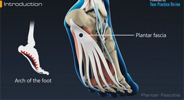 Picture of Plantar Fasciitis