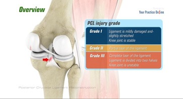 Picture of Posterior Cruciate Ligament Reconstruction