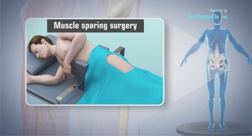 Picture of Posterior Hip Replacement