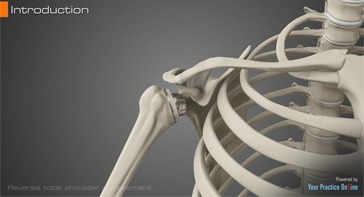 Picture of Reverse Total Shoulder Replacement