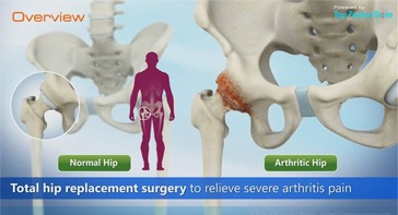 Picture of Revision Hip Replacement