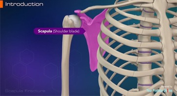 Picture of Scapula Fracture